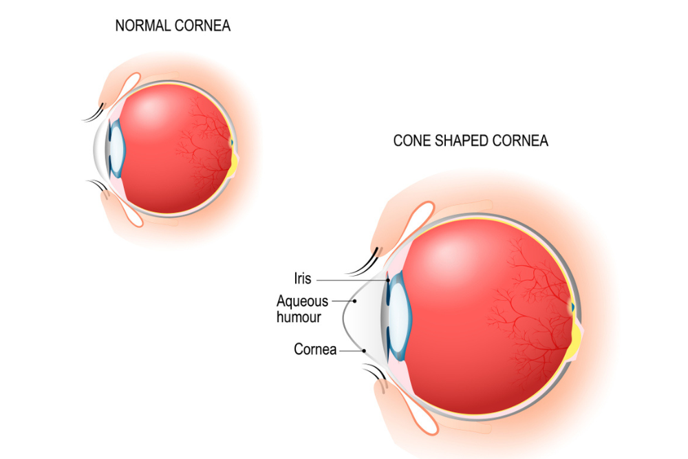 Keratoconus Diagram